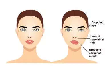 best hospital for facial palsy treatment in Katihar, best doctor for facial palsy treatment in Katihar, cost of facial palsy treatment in Katihar