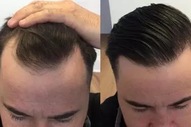 best hospital for hair transplant in Katihar, best doctor for hair transplant in Katihar, cost of hair transplant in Katihar