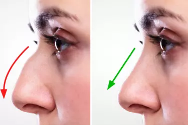 best hospital for nose correction surgery in Katihar, best doctor for rhinoplasty surgery in Katihar, cost of nose correction surgery in Katihar